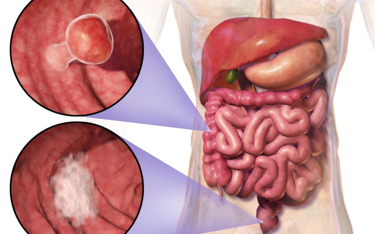 El aumento del cáncer colorrectal en jóvenes de países ricos: ¿qué lo está causando?