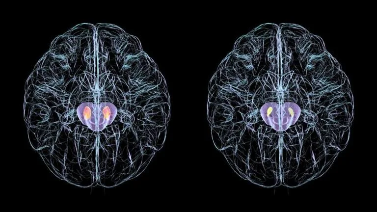 El síntoma silencioso del Parkinson que suele pasar desapercibido durante años